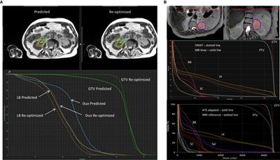 Adaptive Magnetic Resonance-Guided Stereotactic Body Radiotherapy: The Next Step in the Treatment of Renal Cell Carcinoma